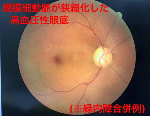 網膜細動脈が狭細化した　高血圧性眼底